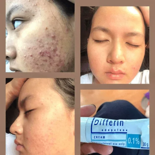 Gel Giảm mụn, thâm GALDERMA Differine Adapalene 0.1% - 30g 5