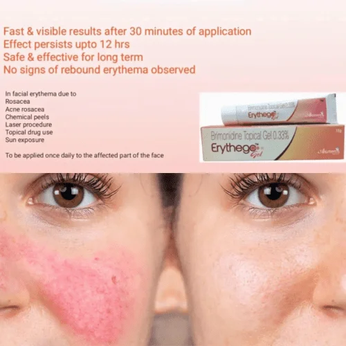 Gel chấm mụn Brimonidine Erythego gel 1