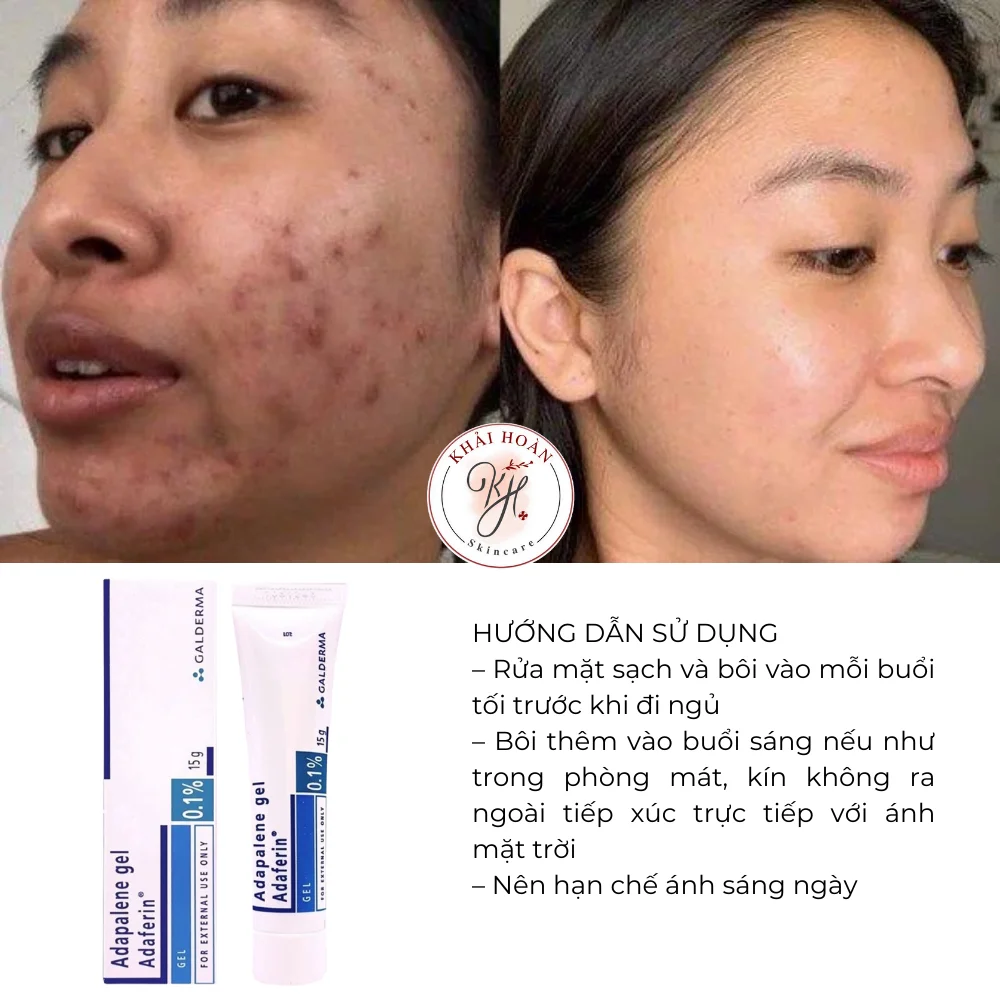 Gel Giảm Mụn Adaferin 0.1% Adapalene 15g 1