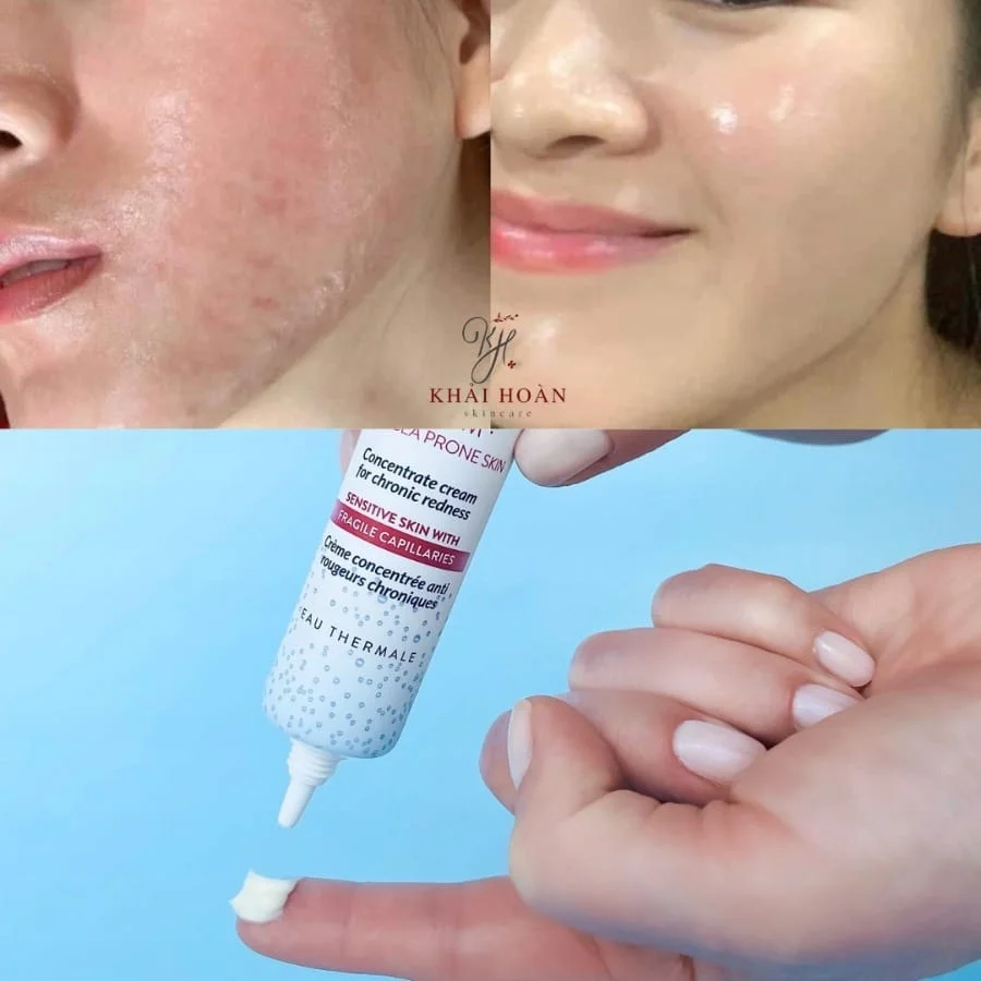 Kem Dưỡng Dermedic Redness làm dịu và phục hồi da bị kích ứng, mẫn đỏ, giãn mao mạch 6