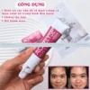 Acnelyse 0.1% điều trị mụn viêm, mụn bọc hiệu quả