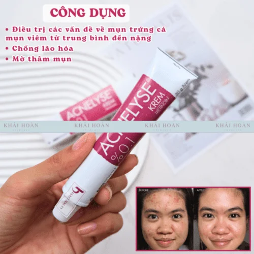Acnelyse 0.1% điều trị mụn viêm, mụn bọc hiệu quả