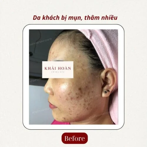 Zebor Azelaic 20% – Giải Pháp Mạnh Cho Da Mụn, Thâm, Sạm Màu 2