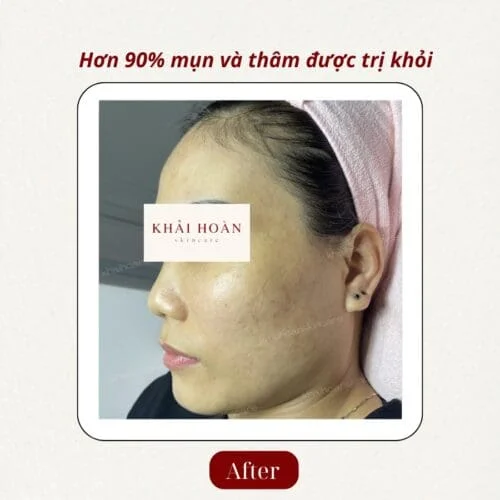 Zebor Azelaic 20% – Giải Pháp Mạnh Cho Da Mụn, Thâm, Sạm Màu 3