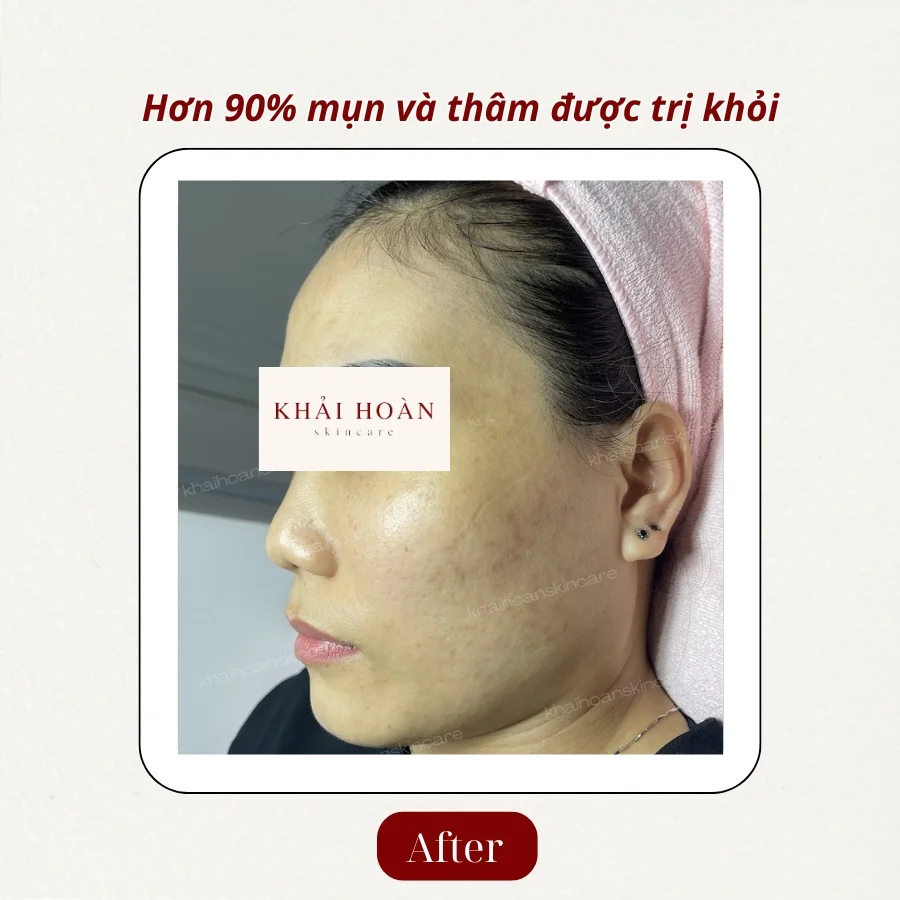 Zebor Azelaic 20% – Giải Pháp Mạnh Cho Da Mụn, Thâm, Sạm Màu 3