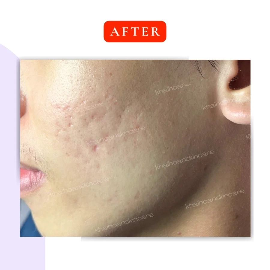 Gel Trị Mụn Klenadap Dapsone 5% - Giải Pháp Cho Da Dầu Mụn 3