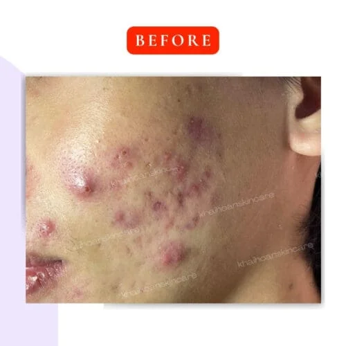 Gel Trị Mụn Klenadap Dapsone 5% - Giải Pháp Cho Da Dầu Mụn 2