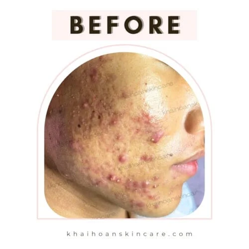 Rubotoon Isotretinoin 10| Đặc Trị Mụn Trứng Cá Nặng, Mụn Bọc 2