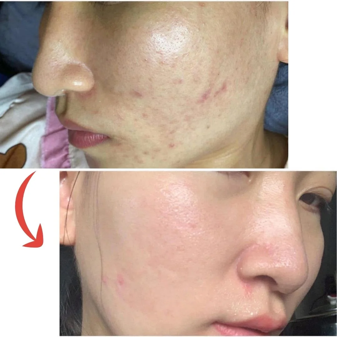 Azemix Gel - Bí Quyết Giảm Mụn, Mờ Thâm, Phục Hồi Da 3