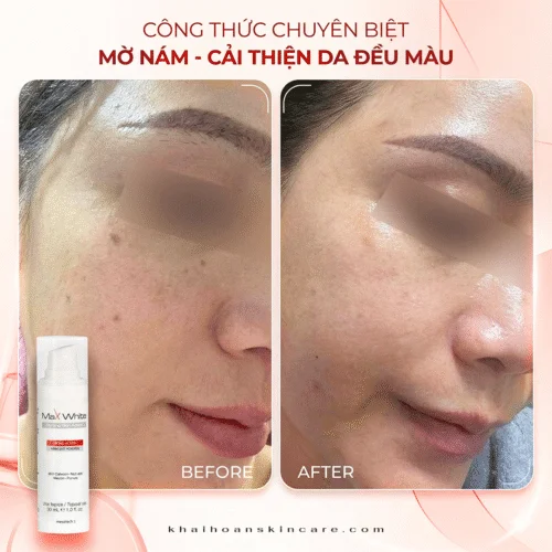 Max White Cream Mesotech 3